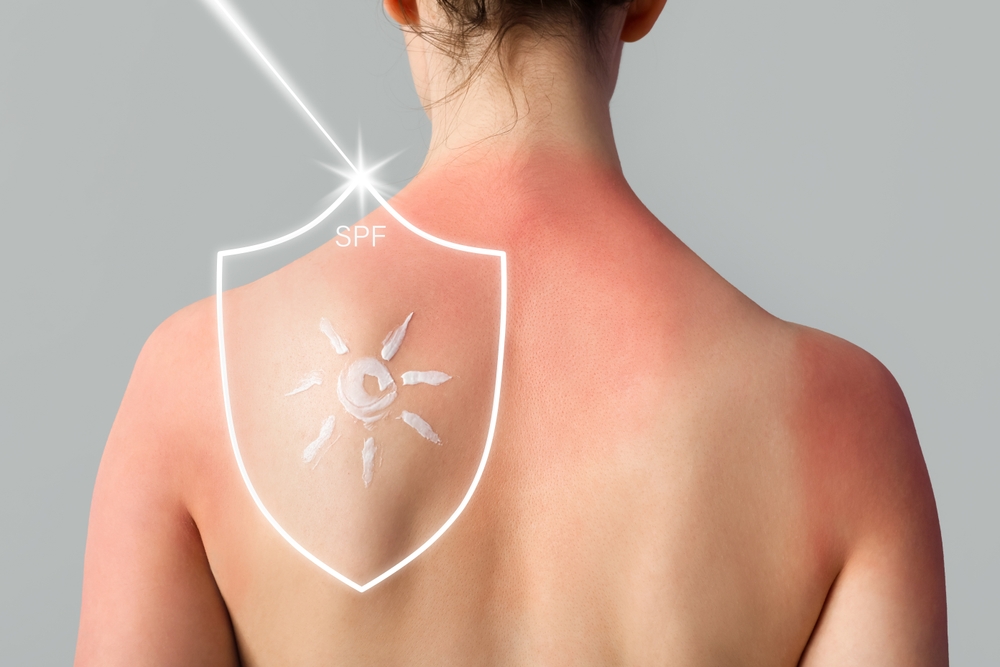 SPF apsauga nudegus saulėje