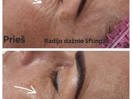 Aparatinė kosmetologija ir veido masažai – kosmetologė Kristina