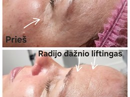 Aparatinė kosmetologija ir veido masažai – kosmetologė Kristina