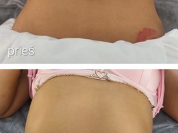 SkinLift RF by Ieva