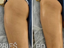 SkinLift RF by Ieva