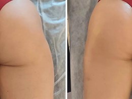 SkinLift RF by Ieva