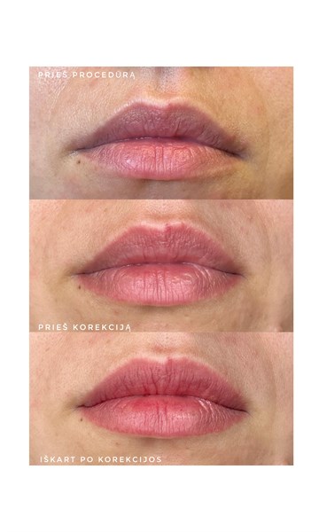 Lūpų mikropigmentacija. Lengvas spalvos įvedimas. SUGIJĘ