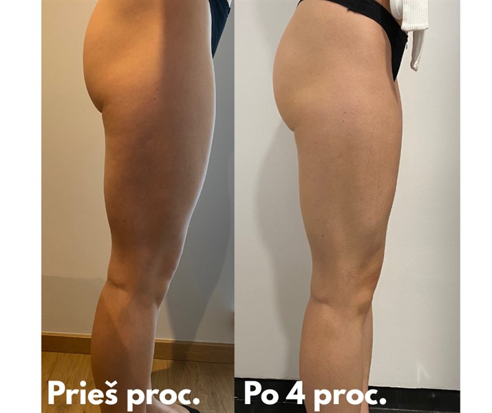 Tavo tobulas užpakaliukas ir kojos – su LipoZero aparatu!