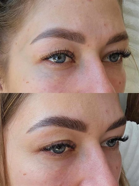 Antakių laminavimas + botoksas