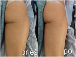 SkinLift RF by Ieva