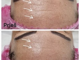 Aparatinė kosmetologija ir veido masažai – kosmetologė Kristina