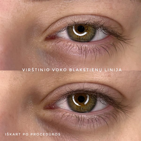 Blasktieninės linijos mikropigmentacija.Iškart po procedūros