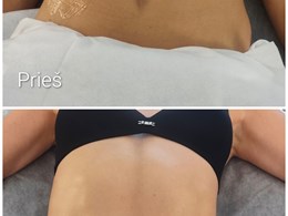 SkinLift RF by Ieva