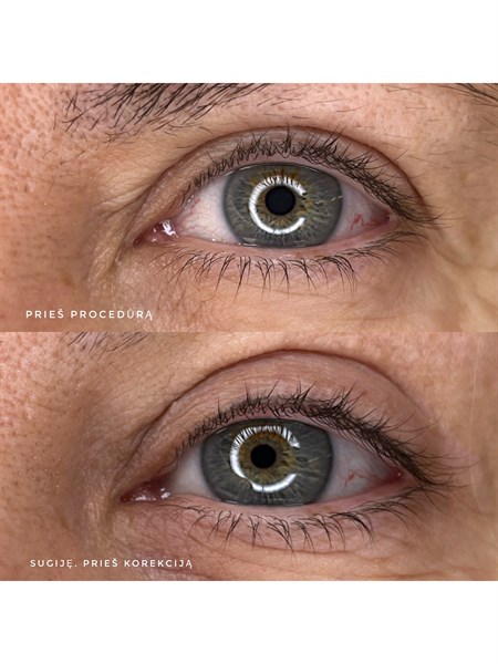 Blasktieninės linijos mikropigmentacija