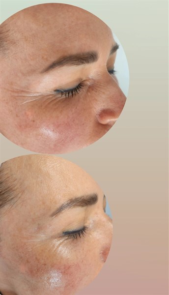 Elektrostimuliacija ir radio dažnis. 
