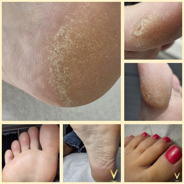 Probleminių pėdų priežiūra