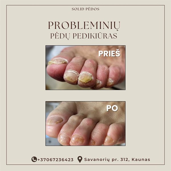 Grybelio pažeisti nagai