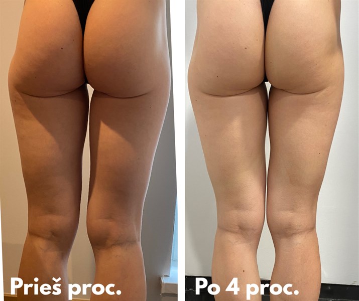 Tavo tobulas užpakaliukas ir kojos – su LipoZero aparatu!
