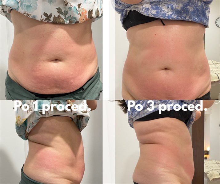 Pilvo ir šonų dailinimas su LipoZeru