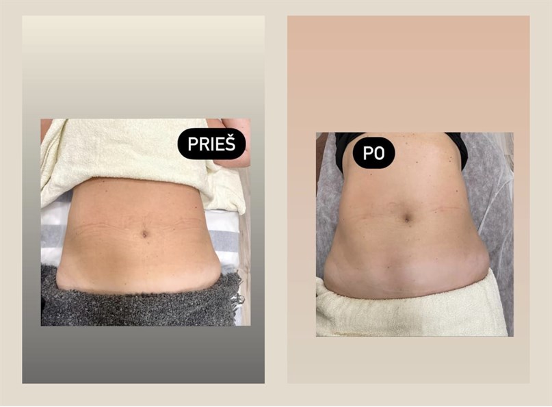  Lipokavitacija, Vakuumas,Radiodažnis  . Po 2 procedūrų
